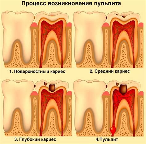 Больно ли удалять нерв из зуба