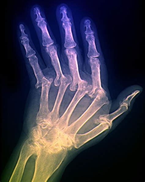 К какому врачу обращаться при болях в суставах пальцев рук