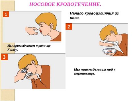 Как остановить кровотечение из носа у ребенка