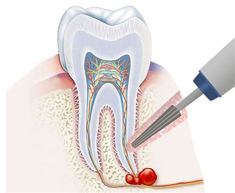 Киста на корне зуба лечение