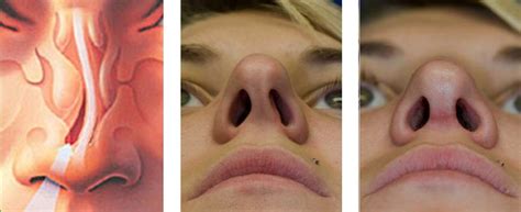 Кривая перегородка носа