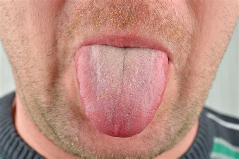 Почему щиплет язык
