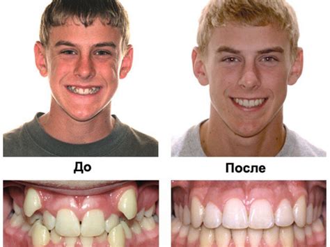 Правильный прикус зубов у человека фото