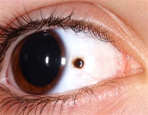 Рак глаз симптомы