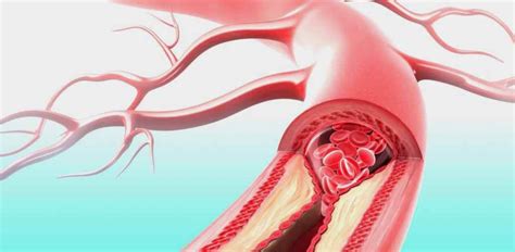 Тромбоз артерий нижних конечностей