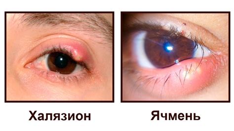 Халязион на глазу лечение у взрослого