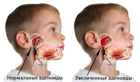 Аденоиды в носу у ребенка